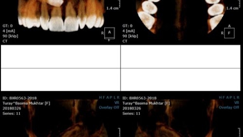 Dental implant and Faciomaxillary centre