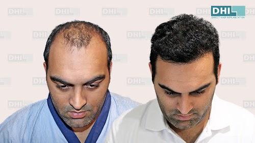 DHI India - Best Hair Transplant in Lucknow