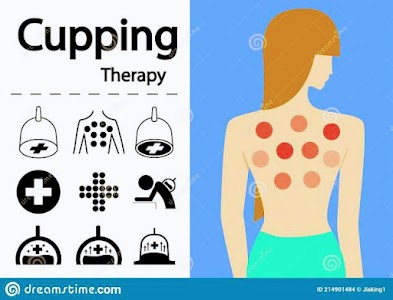 The Hijama (Cupping Therapy) For Ladies